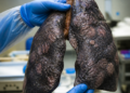 El impacto del Covid-19 en los pulmones de los fallecidos: un estudio sugiere nuevas vías de tratamiento