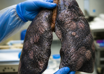 El impacto del Covid-19 en los pulmones de los fallecidos: un estudio sugiere nuevas vías de tratamiento